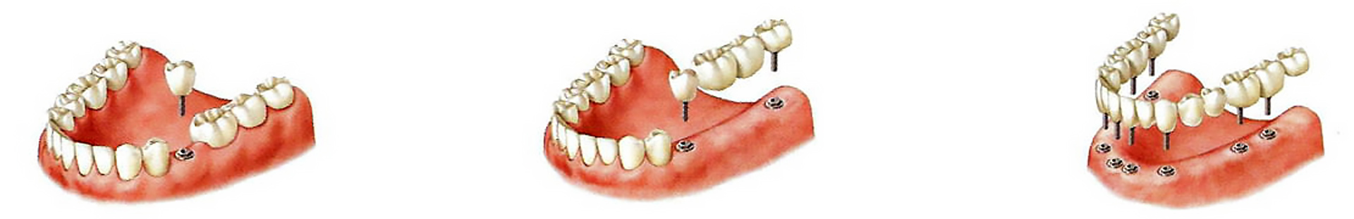 Imagen extraída de la guía ilustrada para pacientes odontológicos de Lacer