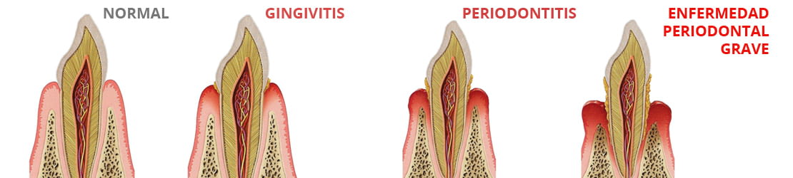 Imagen extraída de la guía ilustrada para pacientes odontológicos de Lacer